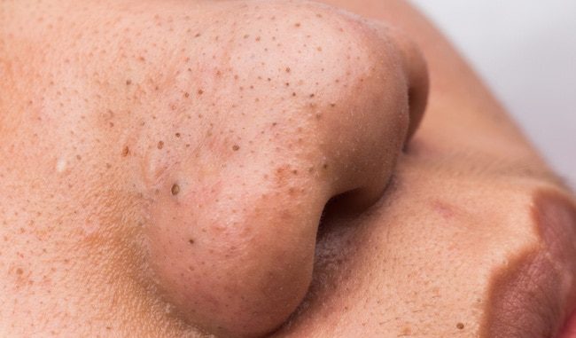 How to remove blackheads from nose?
